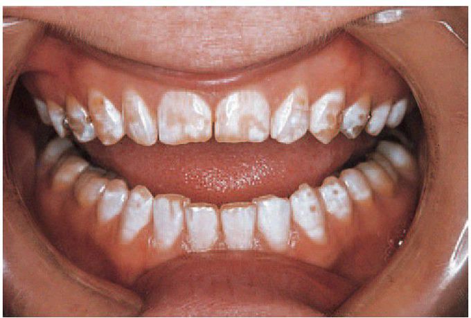 Flouride mottling