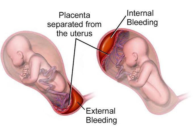 Placenta abruption