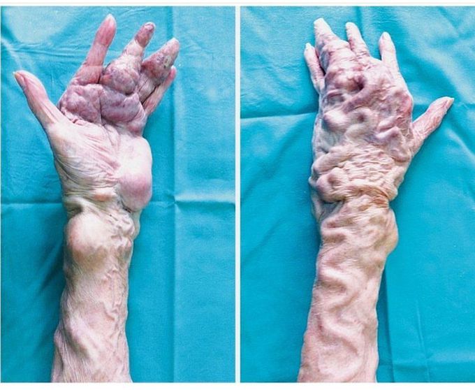 Case of a patient suffering from Parks Weber Syndrome
