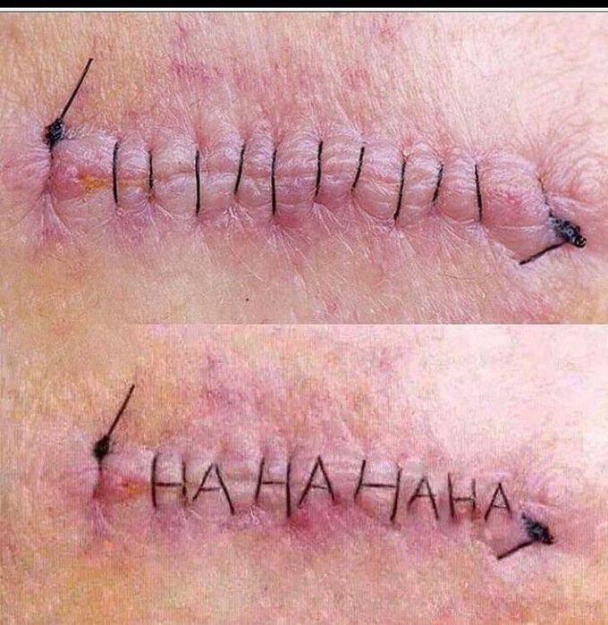 Stitches