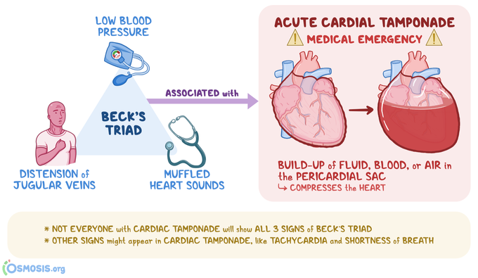 Beck's Triad in Cardiac Tamponade