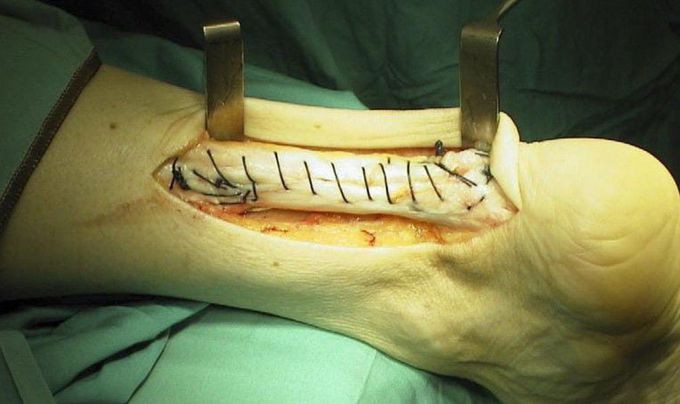 Achilles Tendon Repair