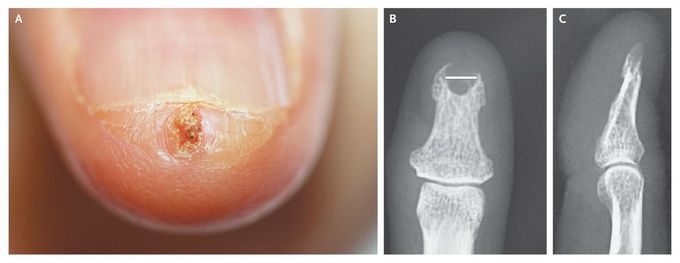 Subungual Tumor of the Thumb