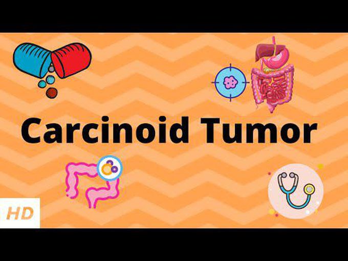 Carcinoid Tumor-Animation