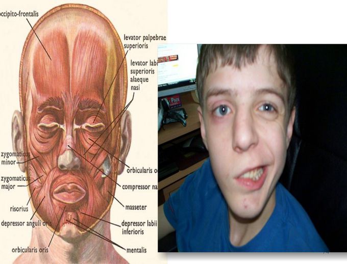 Bell'palsy