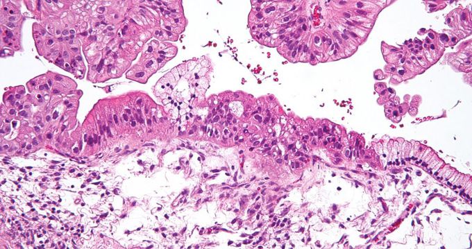 A new study suggests that breastfeeding for as few as 3 months is associated with reduced risk of ovarian cancer.