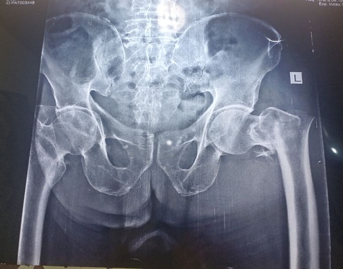 Neck of femur fracture