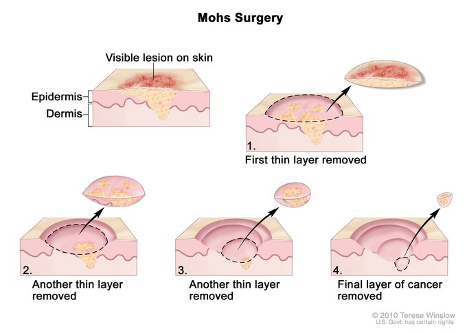 Mohs surgery