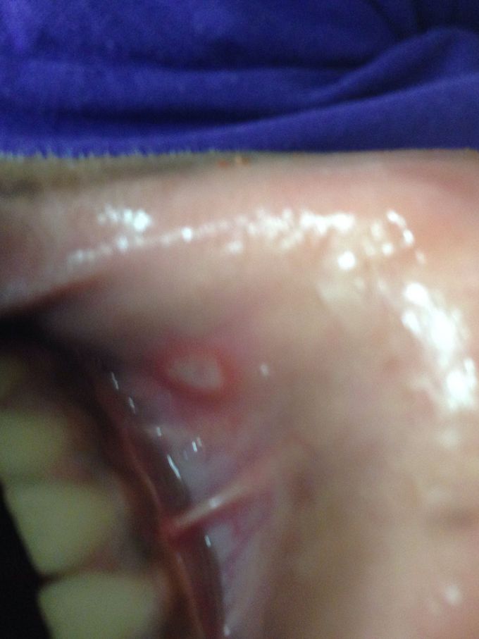 Patient reports having it for a couple weeks now and that it burns whenever she eats,talks,smiles, and in general????
