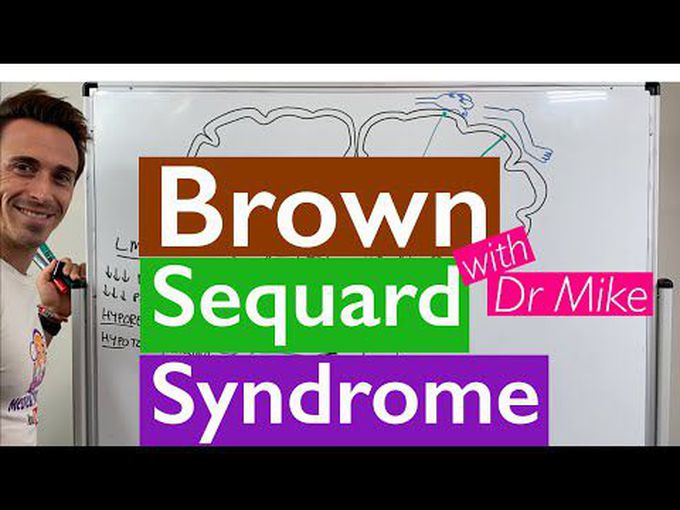 The Brown Sequard Syndrome