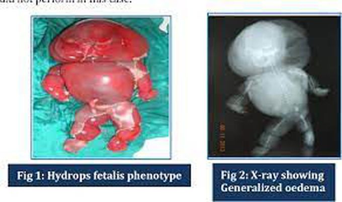 Types of Hydrops Fetalis