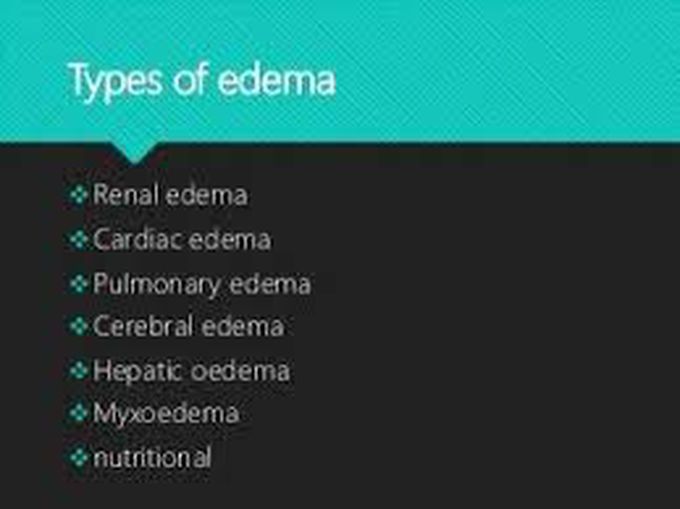 Types of edema