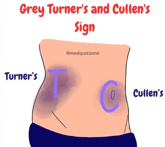 Turner's and Cullen Sign