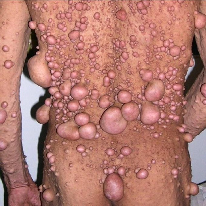 Hundreds of cutaneous neurofibromas associated with neurofibromatosis!! 