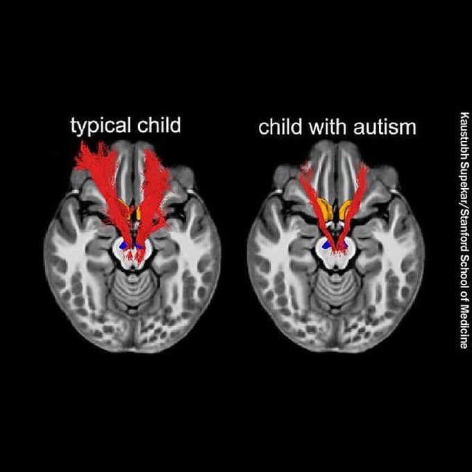 Record-Breaking Autism Rates