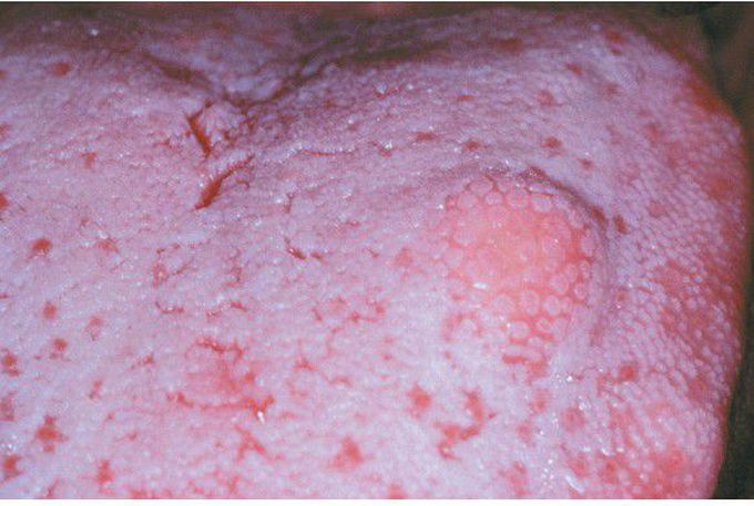 Granular Cell Tumor.