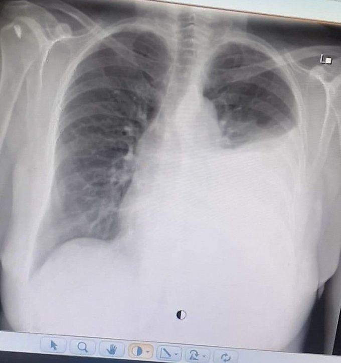 Pulmonary edema