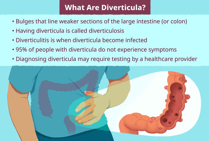 Diverticulosis