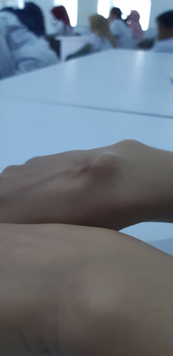 Tarsal