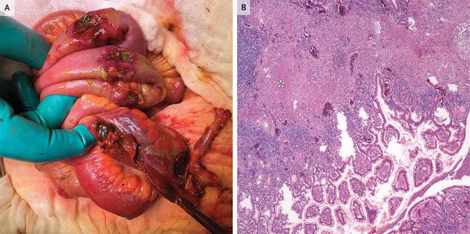 Intestinal Tuberculosis