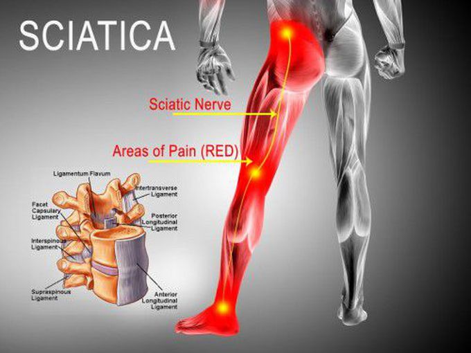 Physical Therapy For Sciatica: Ways To Ease Nerve Pain - physiociti