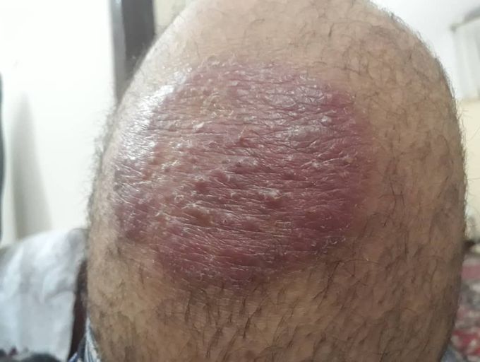 Erythematous skin