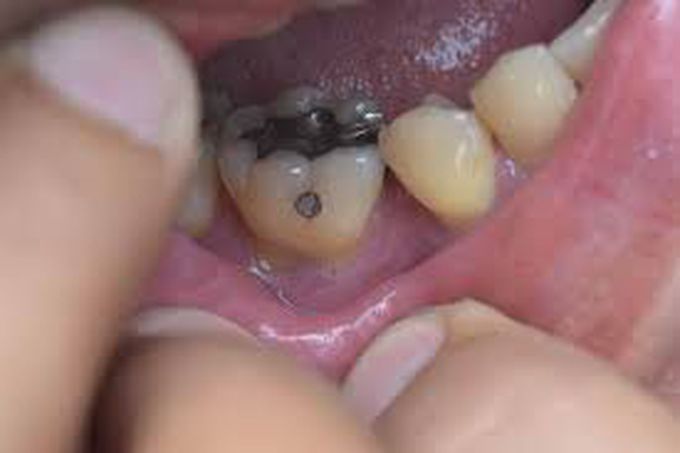 How is tooth decay caused?