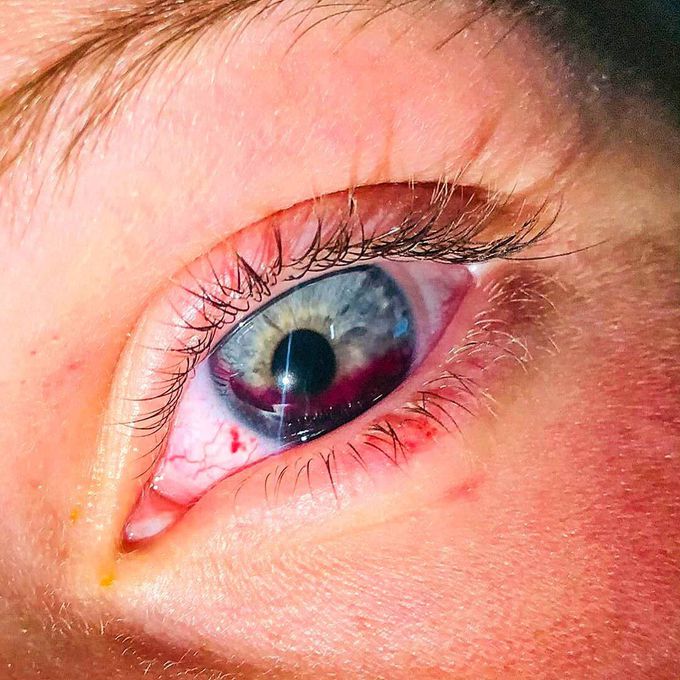 Hyphema
