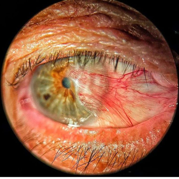 Pterygium