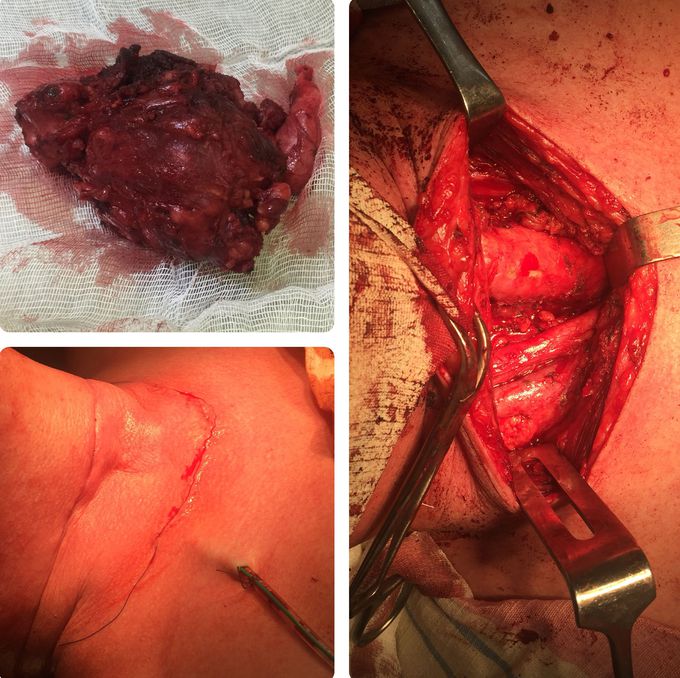 Hemithyroidectomy. Large ugly tumor