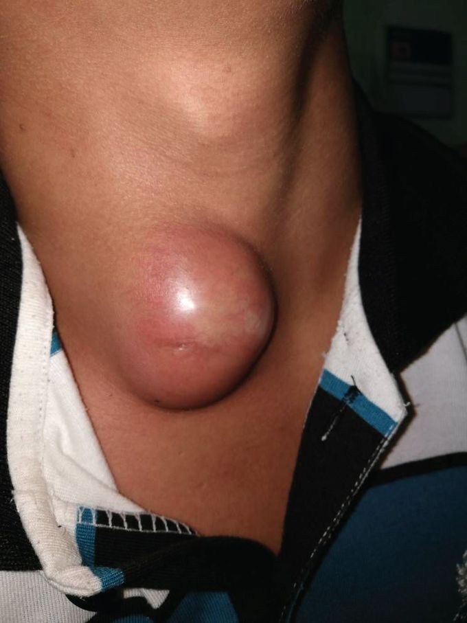 Branchial Cleft Cyst and Blue Urine…. Are The Two Correlated?