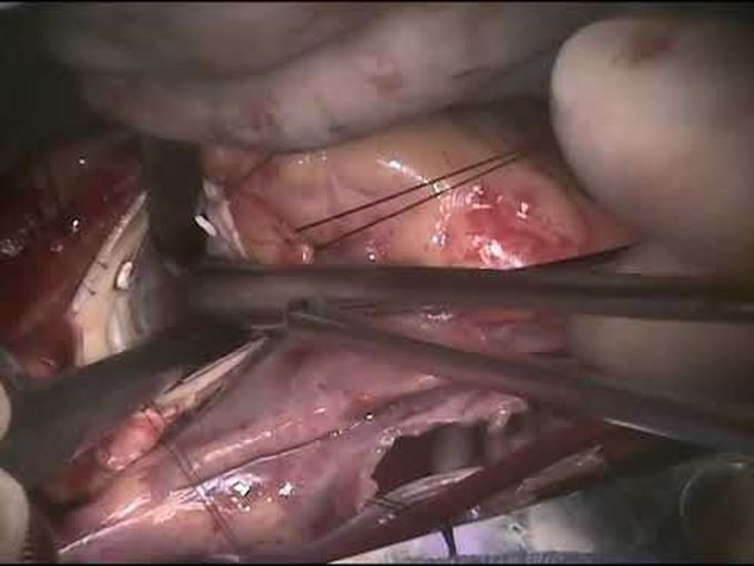 Surgical Treatment of Biventricular Outflow Tract Obstruction in Hypertrophic Cardiomyopathy