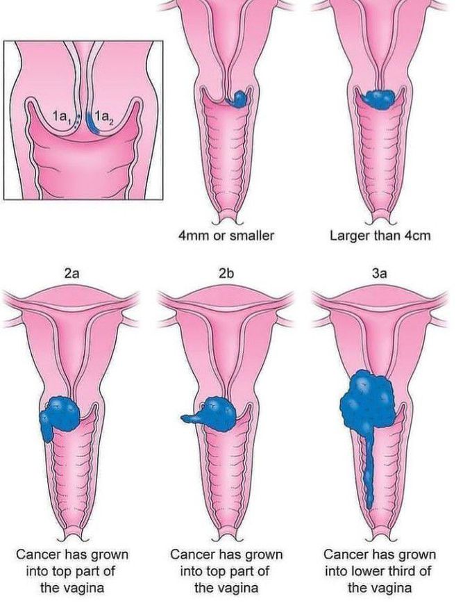 Cervical Cancer