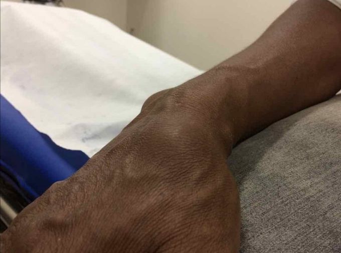 A rare interesting case 
40 year old male , presented with pulsatile mass on the snuffbox for the last 8 days.
Past Medical history and family history was un remarkable (Completely free from any issue)

 *occupational history* was significant، heavily hand user with repetitive hand trauma.
 *Diagnosis*  Aneurysm of the radial artery