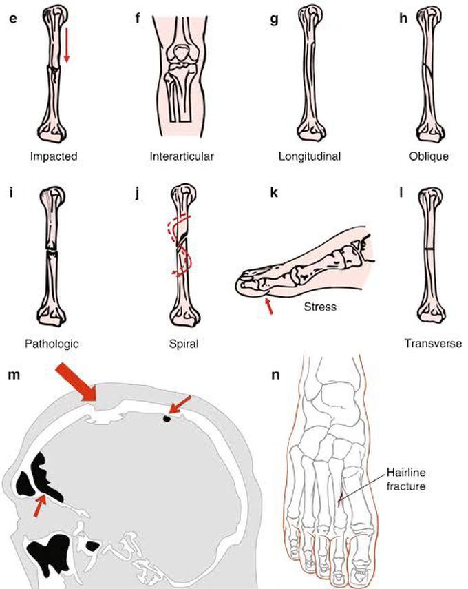 Bone fractures