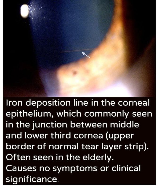 Iron deposition in cornea