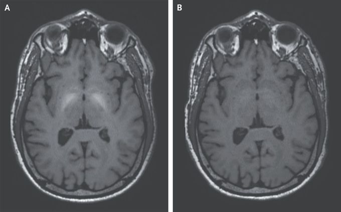 Manganese Accumulation in the Brain