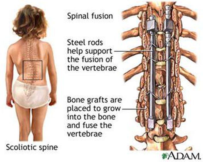 Scoliosis Surgery