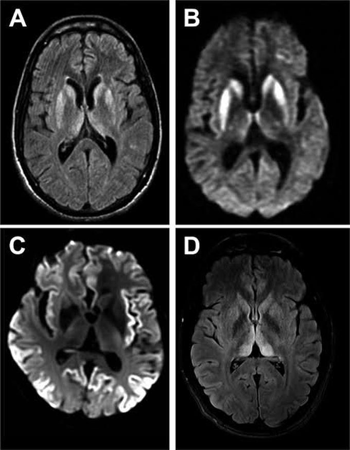 Cruetzfeldt jacobs disease