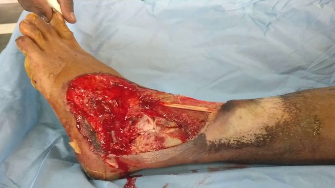 Open ankle joint injury