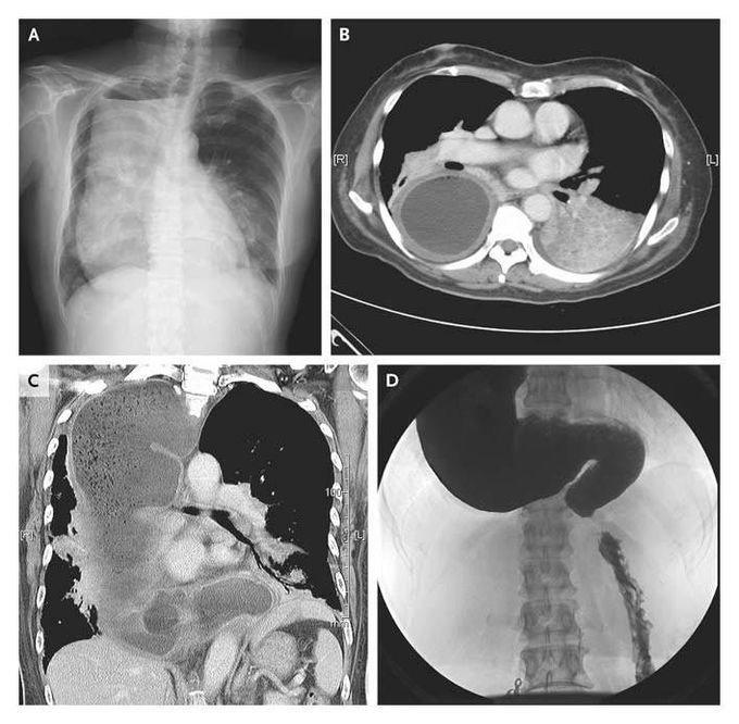 Achalasia