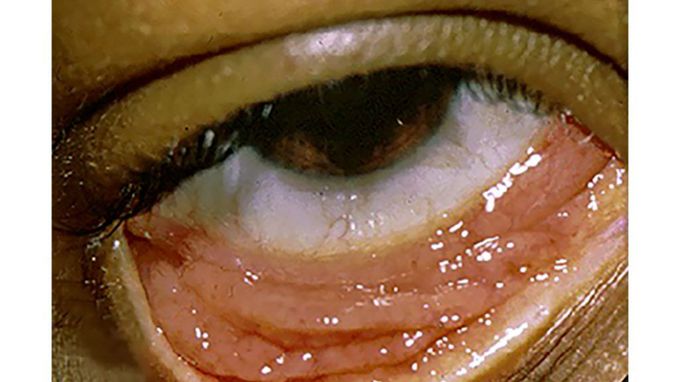 Chlamydia in eyes