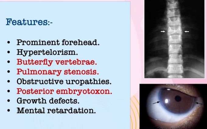 Alagille Syndrome