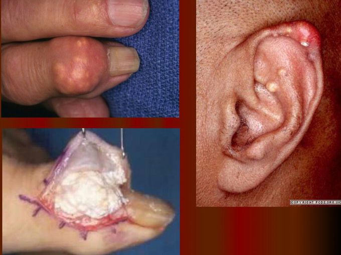 What's the name of this sign in chronic gout ?!!