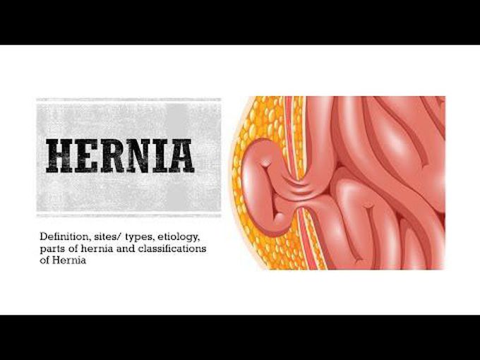 Hernia: Definition, Parts and Classification