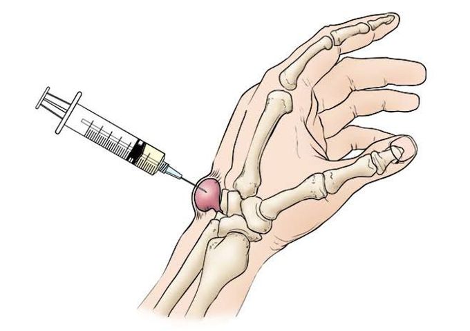 Ganglion cysts