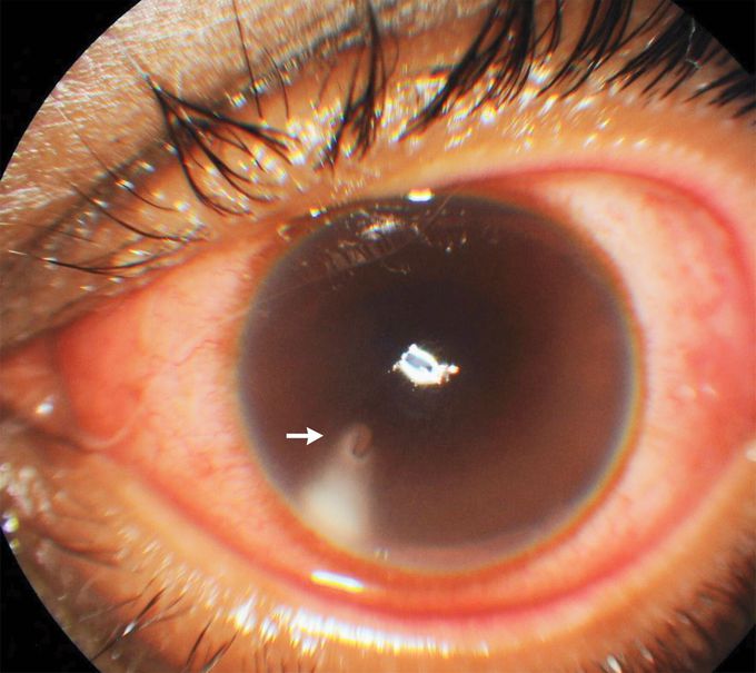 Corneal Bee Sting