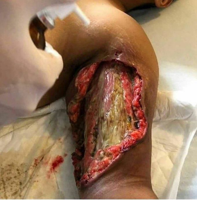 Necrotizing Faciitis...