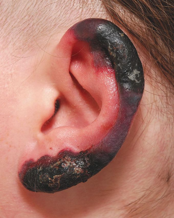 Cutaneous Necrosis Associated with Cold Agglutinins