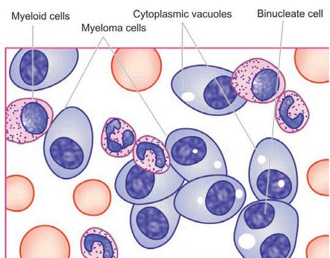 Myeloma